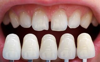 Closeup teeth shaved for veneers model